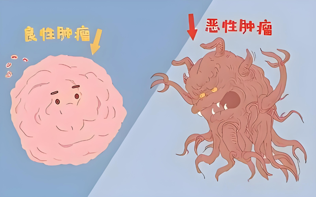 肿瘤分 “好”“坏”！良性 vs 恶性，30 秒分清不恐慌